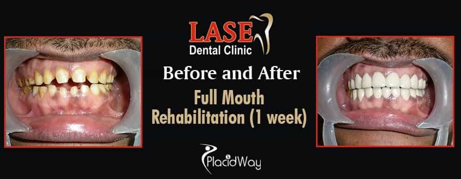 До и после стоматологической помощи в Мумбаи, Индия Before and After Dental Care in Mumbai, India